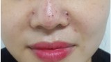 Một phụ nữ bị tắc mạch sau khi tiêm filler nâng mũi vài giờ