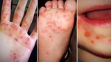 Cách phân biệt bệnh tay chân miệng và thủy đậu