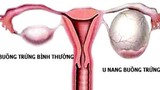 Sự khác biệt giữa ung thư buồng trứng và tử cung