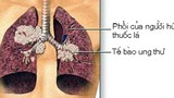 Bí quyết đơn giản giúp tránh xa ung thư phổi