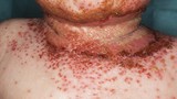 Ngừa được ung thư da nhờ có eczema?