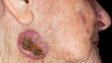 Những dấu hiệu ung thư da thường thấy trên mặt