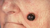 Phát hiện ung thư da từ nốt ruồi đáng ngờ