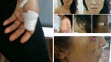 Giáo viên tiểu học bị chồng đánh đập dã man rúng động Phú Thọ