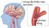 Kết hợp Đông, Tây y điều trị thiểu năng tuần hoàn não 