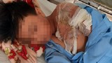 Cha tạt nước sôi khiến con trai bị bỏng nặng: CA Thanh Hoá vào cuộc