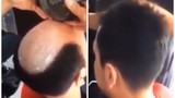 Cách trị hói đầu có một không hai của thợ cắt tóc