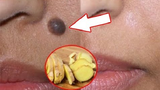 Video: Xóa nốt ruồi không để lại sẹo chỉ với củ gừng