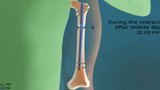 Cận cảnh quy trình phẫu thuật kéo dài chân