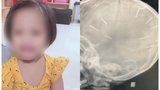 Bé gái bị 9 đinh găm vào đầu ở Hà Nội: Bác sĩ nói gì?