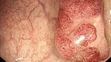 Polyp đường ruột có phát triển thành ung thư ruột kết?