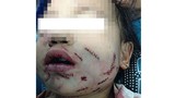 Thương tâm bé gái 8 tuổi bị chó cắn rách mặt