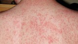 Ca mắc rubella vừa phát hiện ở Hà Nội đã tiêm vaccine 