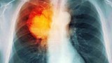 Những điều cần biết về căn bệnh nguy hiểm - ung thư phổi