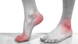 Dấu hiệu chứng tỏ bạn đã mắc bệnh gout