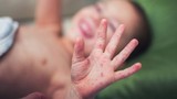 Trẻ bị tay chân miệng trở nặng do chủng vi rút nguy hiểm tái xuất 