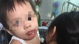 Bé gái 18 tháng bỏng nặng ở miệng, mẹ tố do bảo mẫu