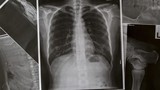 Những dấu hiệu bệnh phổi bạn chớ nên bỏ qua