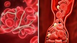 10 cách ngăn ngừa cục máu đông có thể cứu mạng sống