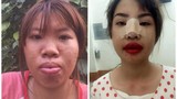 Mẹ đơn thân ở Đăk Nông phẫu thuật thẩm mỹ vì xấu xí