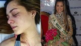 Hoa hậu Trái Đất Venezuela 2012 bị đánh chấn thương cột sống