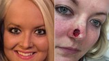 Thiếu nữ bị biến dạng khuôn mặt khủng khiếp do ung thư da