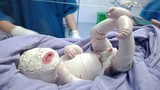 Thương tâm bé sơ sinh mắc bệnh hiếm da toàn thân dày, nứt từng mảng