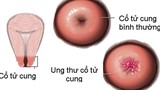 Cách tự phát hiện ung thư cổ tử cung tại nhà