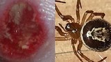 Rùng mình với vết cắn của loài nhện độc nhất nước Anh