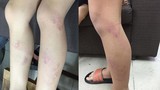 Điểm nóng 24h: Học sinh bị giáo viên đánh tím chân