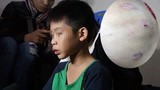 Ảnh: Sẹo chi chít trên người bé 9 tuổi nghi bị bố bạo hành