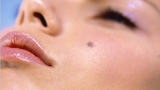 Lý giải những nốt ruồi trên mặt và cơ thể con người