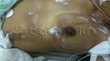 Thai phụ bị sét đánh vào ngực ở Hà Nội được cứu sống