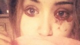 Kỳ lạ cô gái chảy máu ở mắt khiến khoa học bó tay