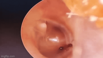 Khoảnh khắc bác sĩ loại bỏ kiến ​​lửa từ bên trong tai bé gái