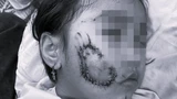 Bị chó cắn, bé gái 5 tuổi ở Quảng Bình phải khâu 50 mũi