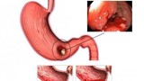 Sau một đêm không ngủ để làm điều này, vợ trẻ nôn ra máu phải cấp cứu