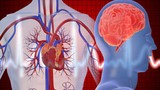 Cách phân biệt đau tim với đột quỵ để tránh mất mạng