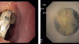 Bác sĩ hết hồn gắp cục pin rỉ trong thực quản cháu bé