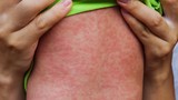 WHO kêu gọi hành động khẩn cấp ứng phó bệnh sởi