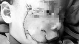 Nghệ An: Đau lòng bé 3 tuổi bị chó nhà  tấn công vùng mặt