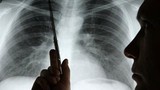 Kéo dài thời gian sống cho bệnh nhân ung thư phổi