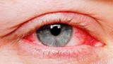 Hải Phòng: Bệnh đau mắt đỏ có nguy cơ bùng phát