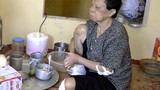 TT Da liễu Hà Đông ăn bớt thuốc của bệnh nhân phong 