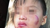 Bé 6 tuổi Bình Phước bị mẹ ruột đánh tím mặt, bầm người: Nguyên nhân càng...phẫn nộ