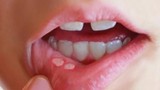 Thường xuyên viêm loét miệng không thể chủ quan, có thể dẫn tới ung thư