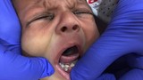 Hy hữu: Bé sơ sinh vừa chào đời đã mọc 7 cái răng