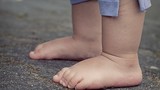 Bàn chân bẹt: Dấu hiệu dị tật không thể chủ quan