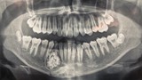 Hi hữu: Lấy gần 100 cái răng trong miệng thiếu niên ở Khánh Hòa