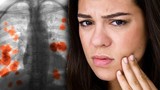 Dấu hiệu lộ trên mặt của ung thư phổi nhưng ít người biết